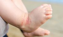 Caring for family members with allergies